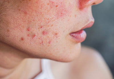 Why does our menstrual cycle cause acne?
