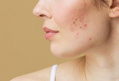 What actually IS Acne??