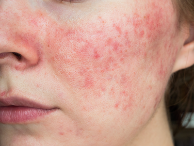 The Low Down on Rosacea