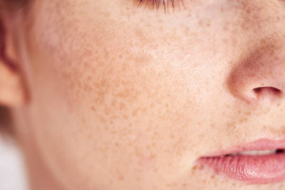 What to do about pigmentation?